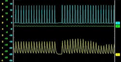 This image shows a low PWM, which results in a reduction in current flow through the throttle motor. Note, in the middle of the trace, both control wires are given a “hard” ground, which causes current flow to cease. This is to allow constant control of the throttle valve and to allow for smooth operation and controlled idle. The PWM is approximately 10-15 percent, and the average voltage is 1A. This image shows a low PWM, which results in a reduction in current flow through the throttle motor. Note, in the middle of the trace, both control wires are given a “hard” ground, which causes current flow to cease. This is to allow constant control of the throttle valve and to allow for smooth operation and controlled idle. The PWM is approximately 10-15 percent, and the average voltage is 1A.
