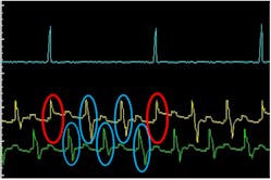 Figure 9- the events within the red circles show a missing portion of the CQ signal. This is the reason the PCM believes a misfire is occurring. Figure 9- the events within the red circles show a missing portion of the CQ signal. This is the reason the PCM believes a misfire is occurring.