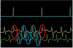 Figure 9- the events within the red circles show a missing portion of the CQ signal. This is the reason the PCM believes a misfire is occurring. Figure 9- the events within the red circles show a missing portion of the CQ signal. This is the reason the PCM believes a misfire is occurring.